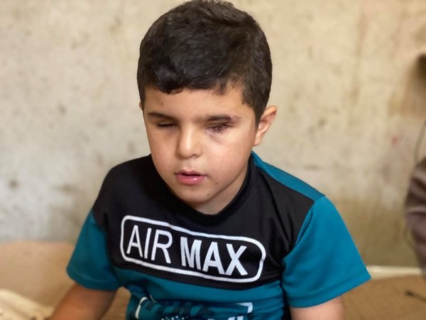 الجميع ذهب إلى المدرسة إلا محمد اصيب في عينه بقصف احتلالي خلال العدوان الاخير