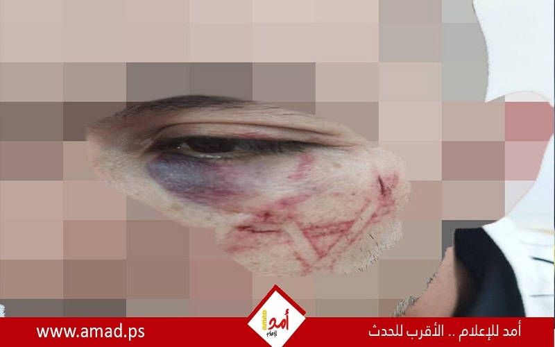 مظهر فاشي .. شرطة الاحتلال تعترف بحفر عناصرها “نجمة داوود” على وجه شاب فلسطيني! مظهر فاشي .. شرطة الاحتلال تعترف بحفر عناصرها “نجمة داوود” على وجه شاب فلسطيني!