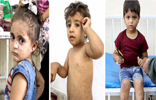 إعلان قطاع غزة منطقة وباء شلل الأطفال والأمراض الجلدية والجسدية تنهش أجسادهم إعلان قطاع غزة منطقة وباء شلل الأطفال والأمراض الجلدية والجسدية تنهش أجسادهم