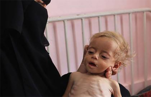 15 ألف طفل يعانون من سوء التغذية في القطاع 15 ألف طفل يعانون من سوء التغذية في القطاع